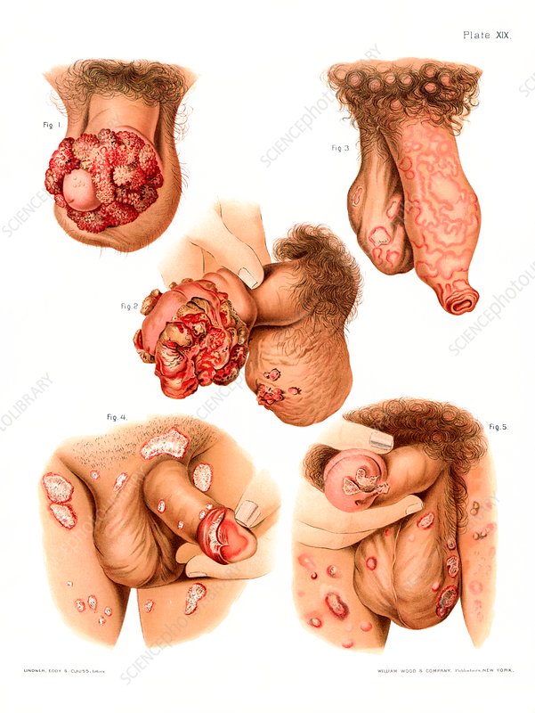 Penis disorders, historical medical illustration. Figs 1 and 2 are cases of genital warts, Figs 3 and 5 are syphilis, and Fig 4 is psoriasis, an autoimmune disease. Syphilis and genital warts are sexually transmitted infections. Syphilis is caused by the bacterium Treponema pallidum and genital warts are caused by the human papilloma virus (HPV). From   Atlas of Venereal and Skin Diseases   by Prince Albert Morrow, published in 1889.